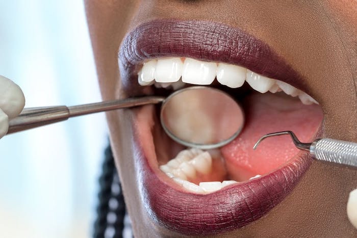 Como prevenir a gengivite na gravidez?