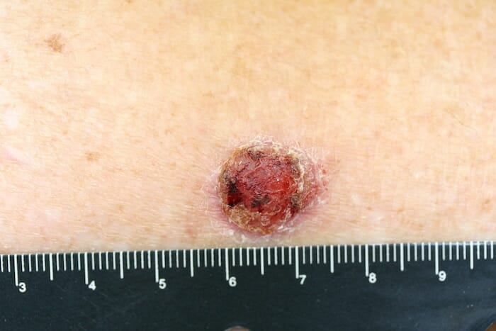 Un medicamento inmunosupresor común puede ocasionar carcinoma de células escamosas