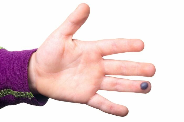¿Qué podría causar ampollas llenas de sangre en el cuerpo?