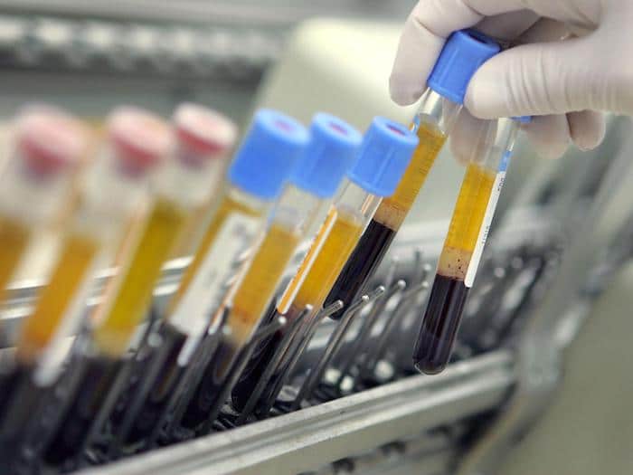 Los investigadores están trabajando arduamente para desarrollar un análisis de sangre "universal" efectivo que mejore la detección del cáncer.
