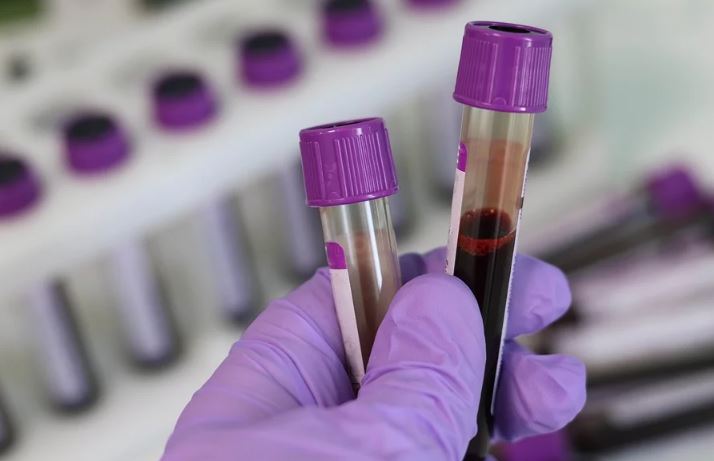 HIV Blood Test