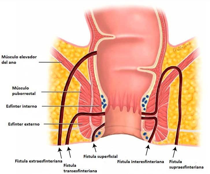 Coloproctología en Córdoba