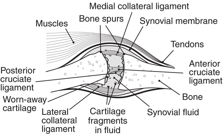 joint with severe osteoarthritis