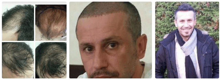 Haartransplantation Im Ausland Acura Pastische Chirurgie