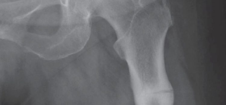 A 71-Year-Old Woman with Femur Pain After a Fall A 71-Year-Old Woman with Femur Pain After a Fall