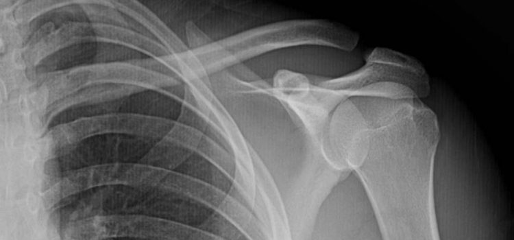 A 35-Year-Old Male with Shoulder Pain After a Fall A 35-Year-Old Male with Shoulder Pain After a Fall