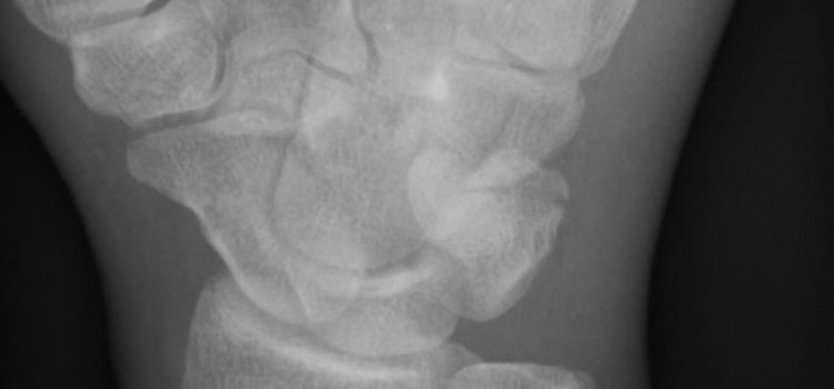 A 28-Year-Old Boxer with Wrist Pain After a Bout A 28-Year-Old Boxer with Wrist Pain After a Bout