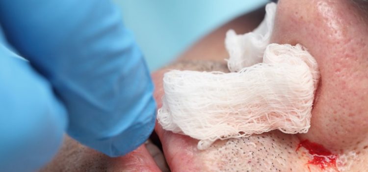 Epistaxis: A Clinical Review Epistaxis: A Clinical Review
