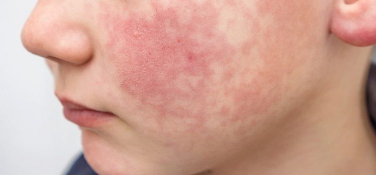 Case of a Nonhealing ‘Sunburn’ on a Toddler Case of a Nonhealing ‘Sunburn’ on a Toddler
