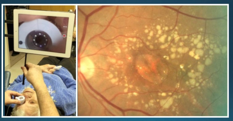 Two images side by side. In the first, a patient lying on her back receives a laser eye treatment for low-vision. The second image is of a retina.