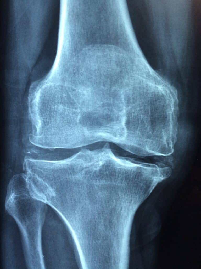 prevenzione dell'osteoporosi
