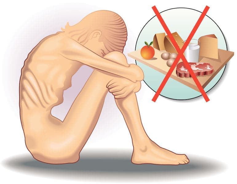 Anorexia
