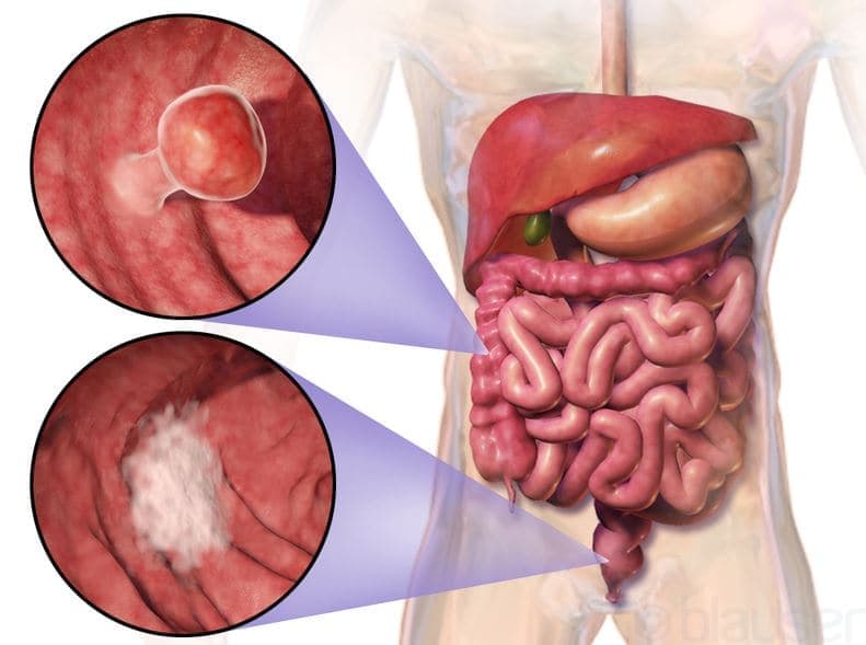 Bowel Cancer