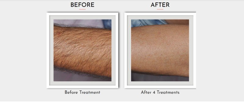 Laser Machine In Hair Removal Effects