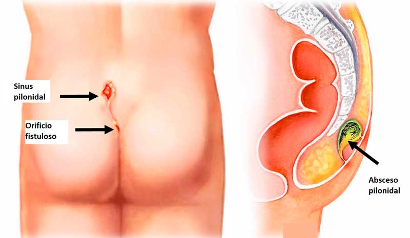 Coloproctología en Córdoba