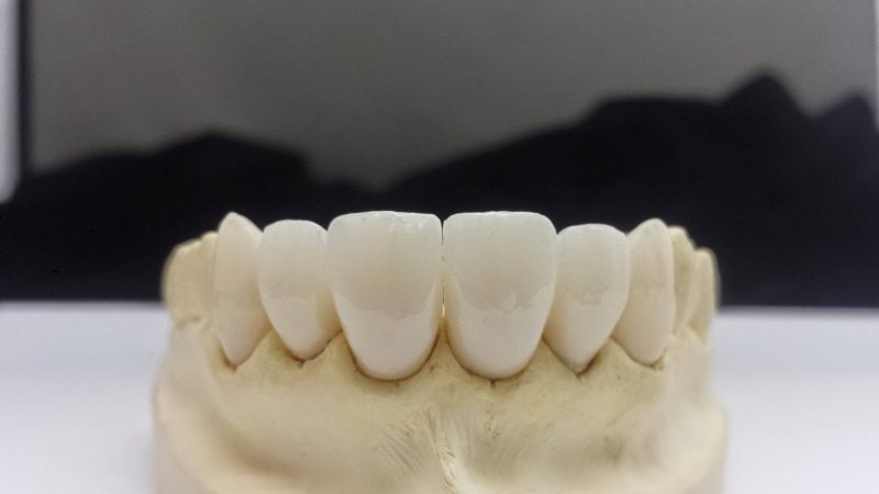 emax Anterior1