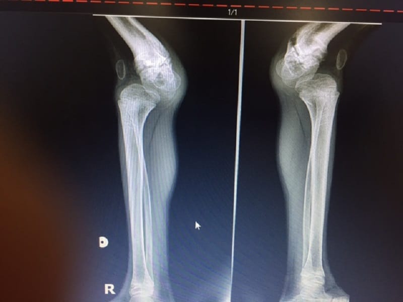 An X-ray of deformed knees