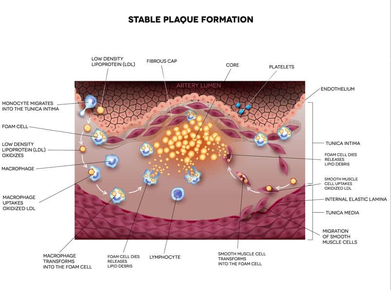 LowDensity Lipoprotein (LDL) in Atherosclerosis and Heart Disease