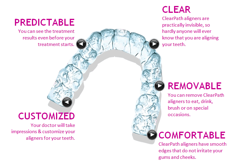Advantages of clear aligners Advantages of clear aligners