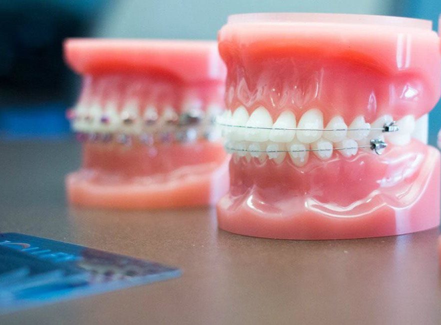 Invisalign Treatment Dubai
