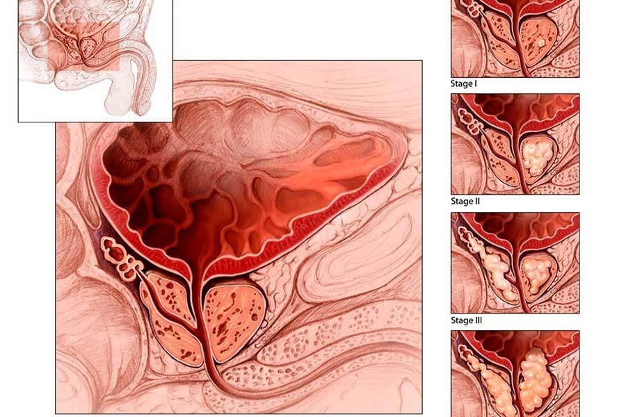 Патологии простаты