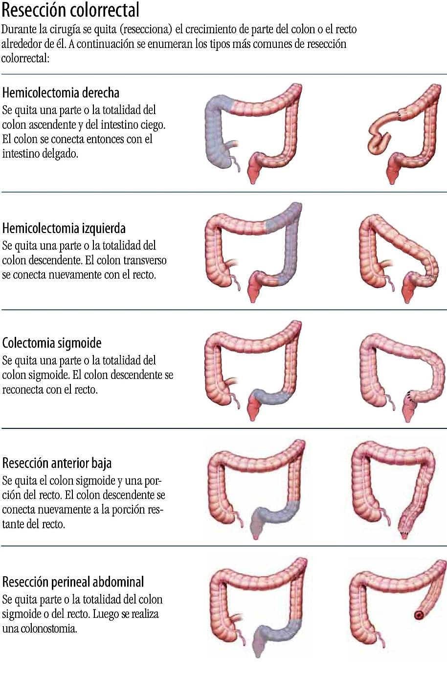Coloproctología en Córdoba