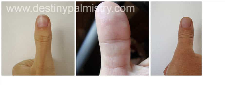 thumb tip, stiff thumb