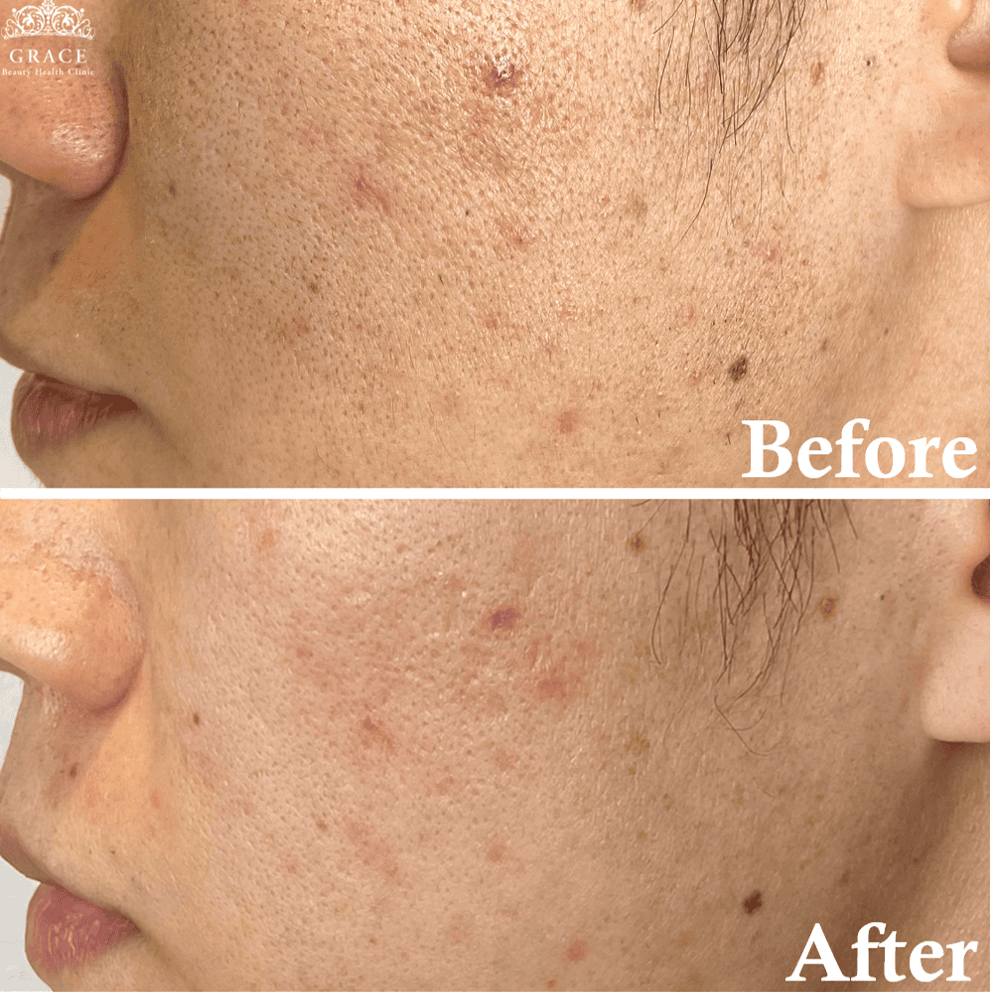 ダーマペン4 公式 Grace Beauty Health Clinic 大阪 心斎橋の美容皮膚科 美容クリニック グレースビューティーヘルスクリニック ダーマペン4 公式 Grace Beauty Health Clinic 大阪 心斎橋の美容皮膚科 美容クリニック グレースビューティーヘルスクリニック