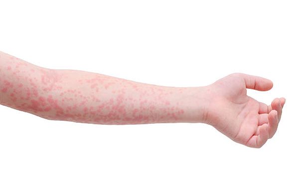 scarlet fever Scarlet Fever, Scarlet Fever in Children-Know What to Do During an Outbreak, Family Homeschooler