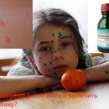 Как вовремя распознать и вылечить ветрянку?