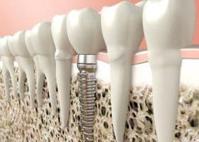 Costa Rica Dental Implants & Surgery Costa Rica Dental Boutique