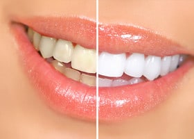 Zoom Whitening System