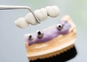 Costa Rica Dental Bridges