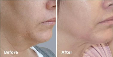 results-forma-skin-tightening-03-img