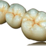 emax