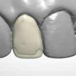 veneer_design