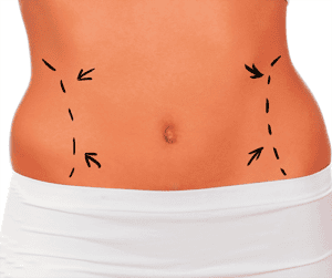 Abdominoplastia