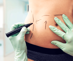 Abdominoplastia