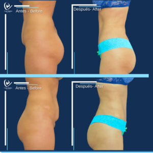 ABDOMINOPLASTIA-2
