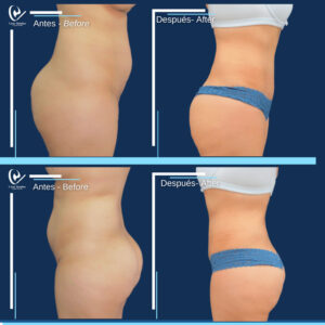 ABDOMINOPLASTIA-3