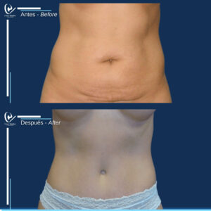 ABDOMINOPLASTIA