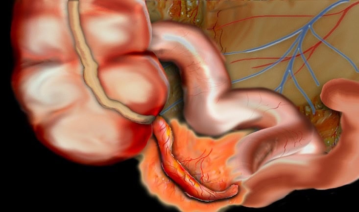 a5097976825266_Appendicitis2.jpg