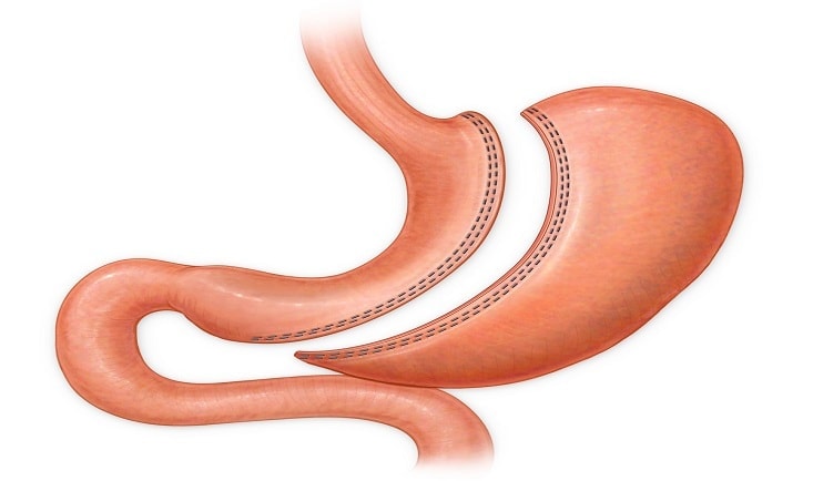 Sleeve_Gastrectomy.jpg