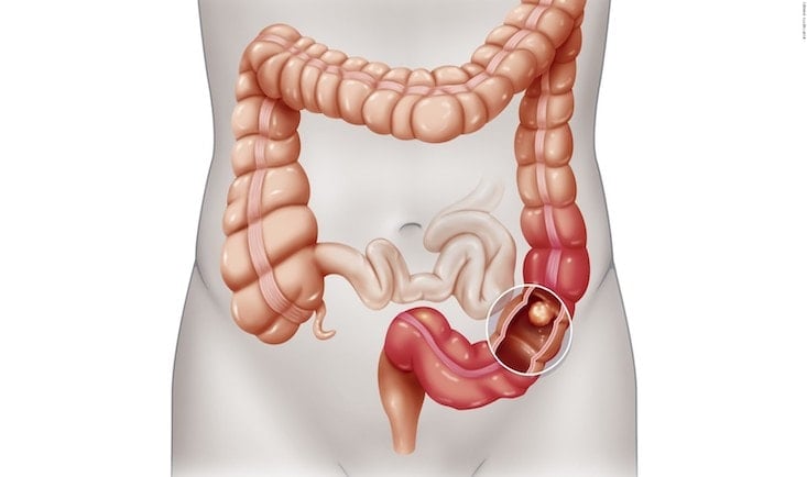 Cancerul-de-colon.jpg