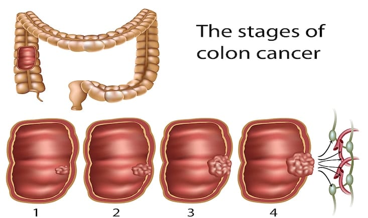 Cancer-colon-stadii.jpg