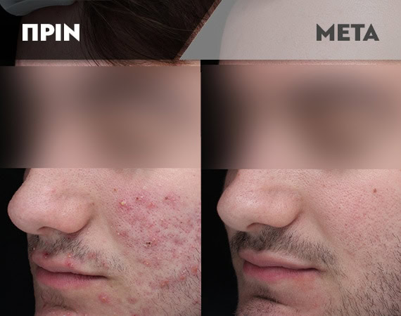 Results-Acne