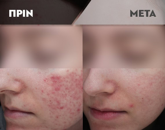 Results-Acne16