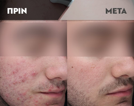 Results-Acne2