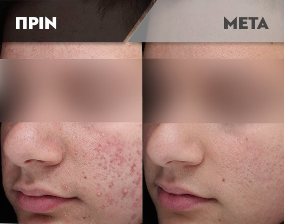 Results-Acne3