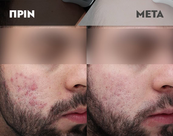 Results-Acne4